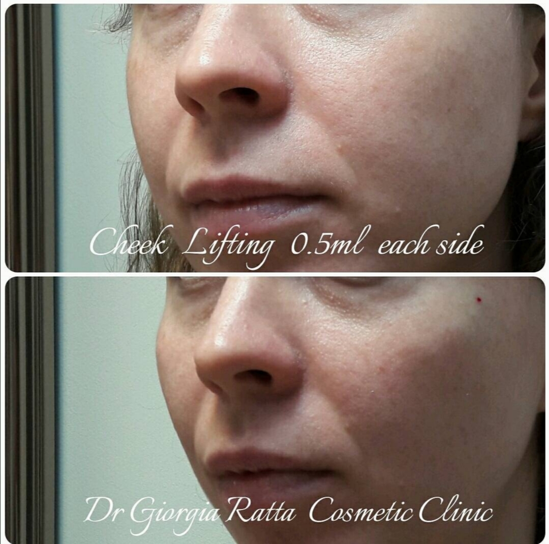 Dr Giorgia Ratta - before and after treatment image