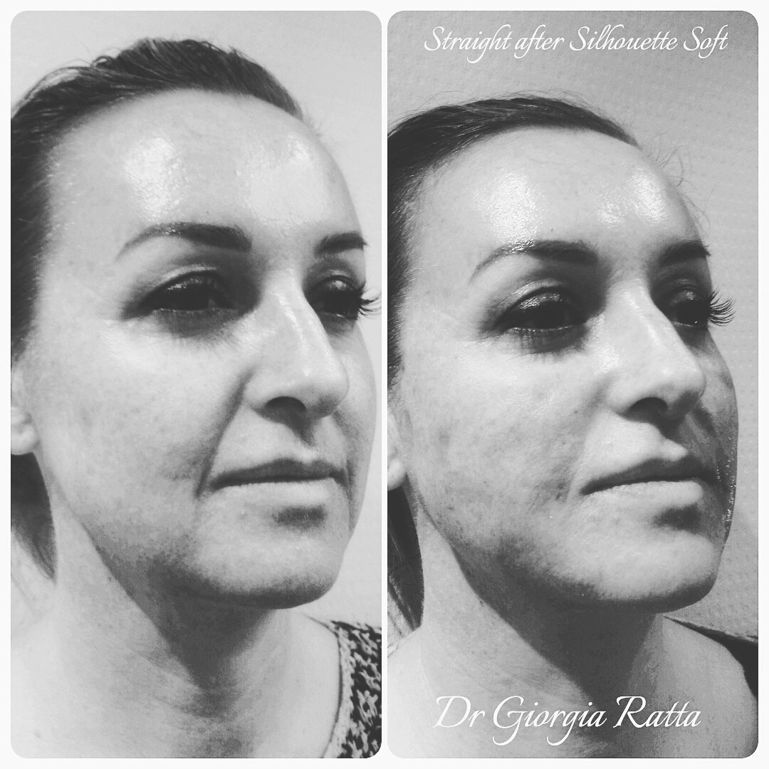 Dr Giorgia Ratta - before and after treatment image