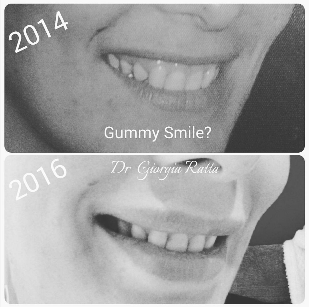 Dr Giorgia Ratta - before and after treatment image