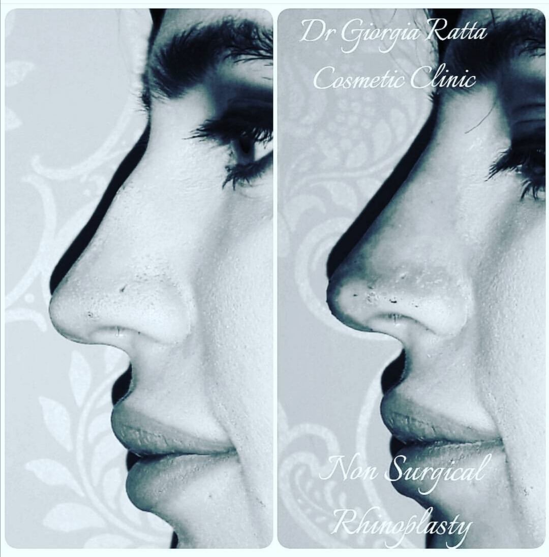 Dr Giorgia Ratta - before and after treatment image