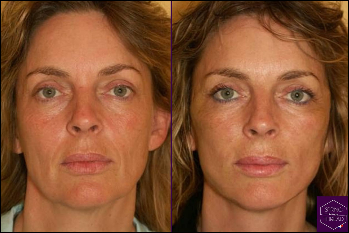 Dr Giorgia Ratta - Generation Aesthetics Clinics - Spring Thread Lift